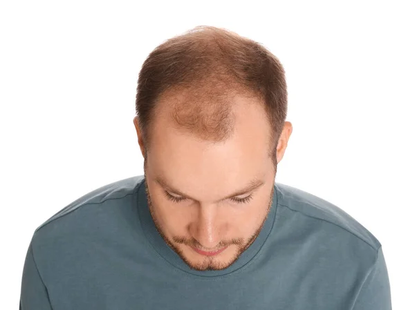 Muž Problémem Vypadávání Vlasů Izolované Bílém Nad Pohled Trichologická Léčba — Stock fotografie
