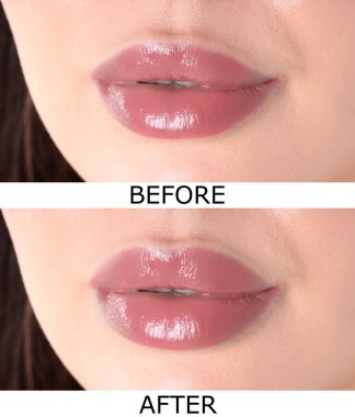 Dudak büyütme, kolaj. Kadın estetik ameliyattan önce ve sonra dudaklarını gösteriyor.