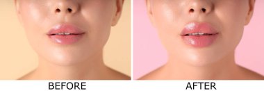 Dudak büyütme, kolaj. Kadın estetik ameliyattan önce ve sonra dudaklarını gösteriyor.