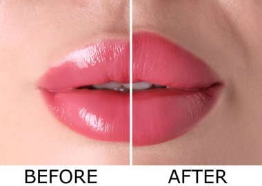 Yükseltme işleminden önce ve sonra kadın dudakları, yakın plan. Fotoğraf ikiye bölündü.