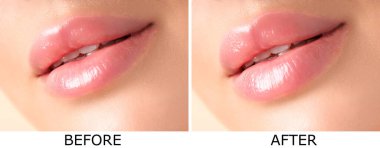 Dudak büyütme, kolaj. Kadın estetik ameliyattan önce ve sonra dudaklarını gösteriyor.