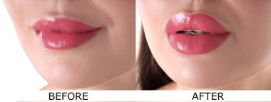 Dudak büyütme, kolaj. Kadın estetik ameliyattan önce ve sonra dudaklarını gösteriyor.