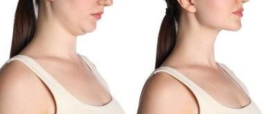 Ameliyattan önce ve sonra iki çeneli kadın, yakın plan. Beyaz arkaplanda fotoğrafların kolajı