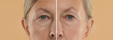 Bej arka planda yaşlanmayı önleyen tedavi öncesi ve sonrası kadın, yakın plan. Cilt gençleşmesini gösteren kolaj