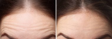 Yaşlanma karşıtı tedavi öncesi ve sonrası kadın, yakın çekim. Cilt gençleşmesini gösteren kolaj