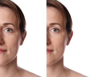 Beyaz arka planda yaşlanmayı önleyen tedavi öncesi ve sonrası kadın, yakın plan. Cilt gençleşmesini gösteren kolaj