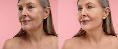 Pembe arka planda yaşlanmayı önleyen tedavi öncesi ve sonrası kadın, yakın plan. Cilt gençleşmesini gösteren kolaj
