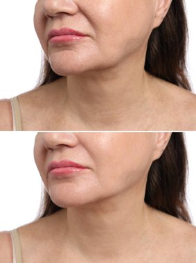 Beyaz arka planda yaşlanmayı önleyen tedavi öncesi ve sonrası kadın, yakın plan. Cilt gençleşmesini gösteren kolaj