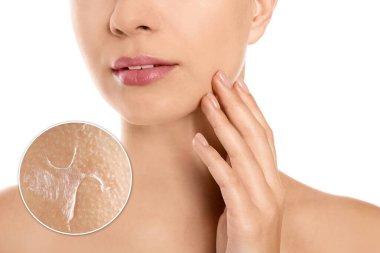 Yanağı büyümüş, derisi pul pul olmuş. Beyaz arka plandaki kadın, yakın plan.