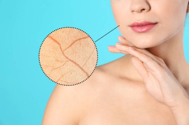 Yanağı büyümüş, derisi çatlamış. Açık mavi arka plandaki kadın, yakın plan.