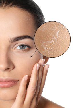 Yanağı büyümüş, derisi pul pul olmuş. Beyaz arka planda güzel bir kadın, yakın plan.