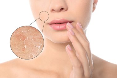 Yanak bölgesinde kurumuş pullu deri görünüyor. Beyaz arka plandaki kadın, yakın plan.