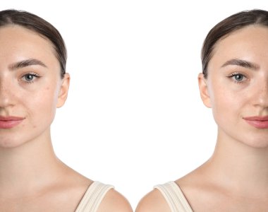 Kadın estetik ameliyattan önce ve sonra cildini gösteriyor. Beyaz arkaplanda kolaj