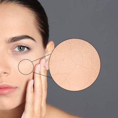 Yanak bölgesine yakınlaştırdım. Çatlaklı kuru deri görünüyor. Gri arka planda güzel bir kadın, yakın plan.