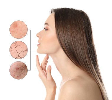 Cilt problemleri (sivilce, kuru) gösteren büyütülmüş bölgeler. Beyaz arka planda güzel bir kadın