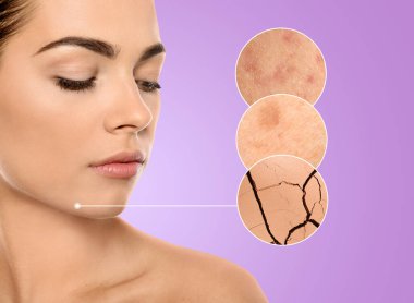 Cilt problemleri (sivilce, kuru) gösteren büyütülmüş bölgeler. Menekşe eğimli arkaplanda güzel bir kadın