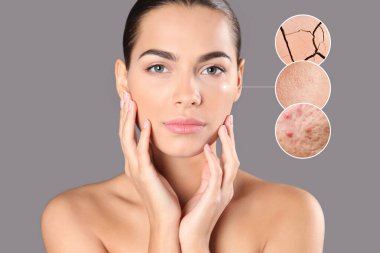 Cilt problemleri (sivilce, kuru) gösteren büyütülmüş bölgeler. Gri arka planda güzel bir kadın