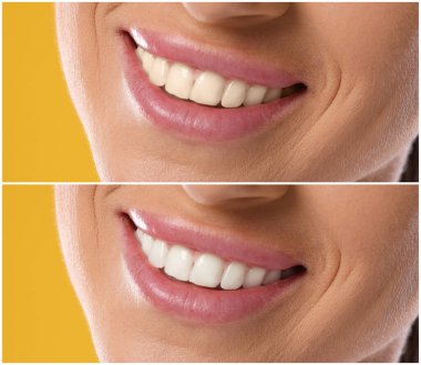 Diş beyazlatma tedavisinden önce ve sonra gülümseyen kadın, yakın plan. Turuncu arkaplanda kolaj