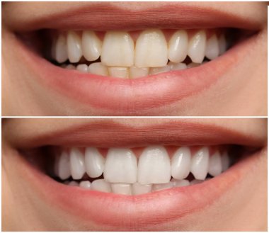 Diş beyazlatma tedavisinden önce ve sonra gülümseyen kadın, yakın plan. Kolaj