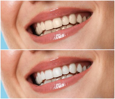 Diş beyazlatma tedavisinden önce ve sonra gülümseyen kadın, yakın plan. Kolaj