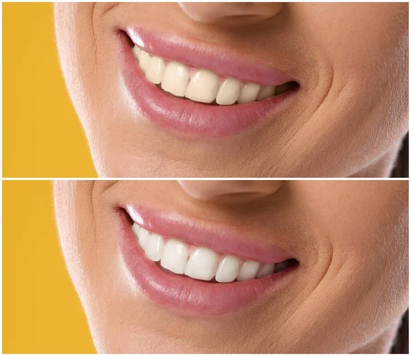 Diş beyazlatma tedavisinden önce ve sonra gülümseyen kadın, yakın plan. Turuncu arkaplanda kolaj