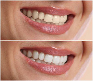 Diş beyazlatma tedavisinden önce ve sonra gülümseyen kadın, yakın plan. Kolaj