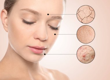 Cilt problemleri (sivilce, kuru) gösteren büyütülmüş bölgeler. Bej arka planda güzel bir kadın