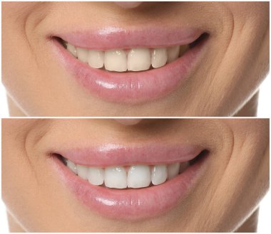 Diş beyazlatma tedavisinden önce ve sonra gülümseyen kadın, yakın plan. Kolaj