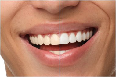 Diş beyazlatma tedavisinden önce ve sonra gülümseyen adam, yakın plan. Kolaj ikiye bölündü