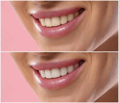 Diş beyazlatma tedavisinden önce ve sonra gülümseyen kadın, yakın plan. Pembe arkaplanda kolaj