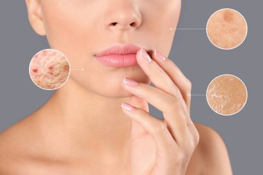 Cilt problemleri (sivilce, kuru) gösteren büyütülmüş bölgeler. Gri arka planda güzel bir kadın, yakın plan.