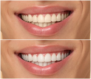 Diş beyazlatma tedavisinden önce ve sonra gülümseyen adam, yakın plan. Kolaj