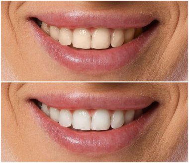 Diş beyazlatma tedavisinden önce ve sonra gülümseyen kadın, yakın plan. Kolaj
