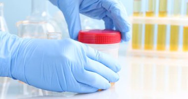 Üroloji. Laboratuvar çalışanı beyaz masadaki konteynırdan idrar örneği alıyor açık mavi arka plan, yakın plan