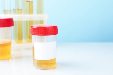 Üroloji. Üzerinde analiz için idrar örnekleri olan kaplar ve beyaz masadaki tüpler açık mavi arka planda, yakın plan. Metin için boşluk