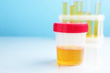 Üroloji. Üzerinde analiz için idrar örneği olan kap ve beyaz masada açık mavi arka planda test tüpleri, yakın plan. Metin için boşluk