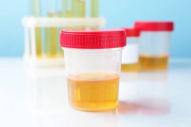 Üroloji. Üzerinde analiz için idrar örnekleri olan kaplar ve beyaz masadaki tüpler açık mavi arka planda, yakın plan