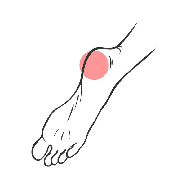 脚后跟疼痛 骨科疾病 足底筋膜炎 矢量孤立的轮廓说明 — 图库矢量图片