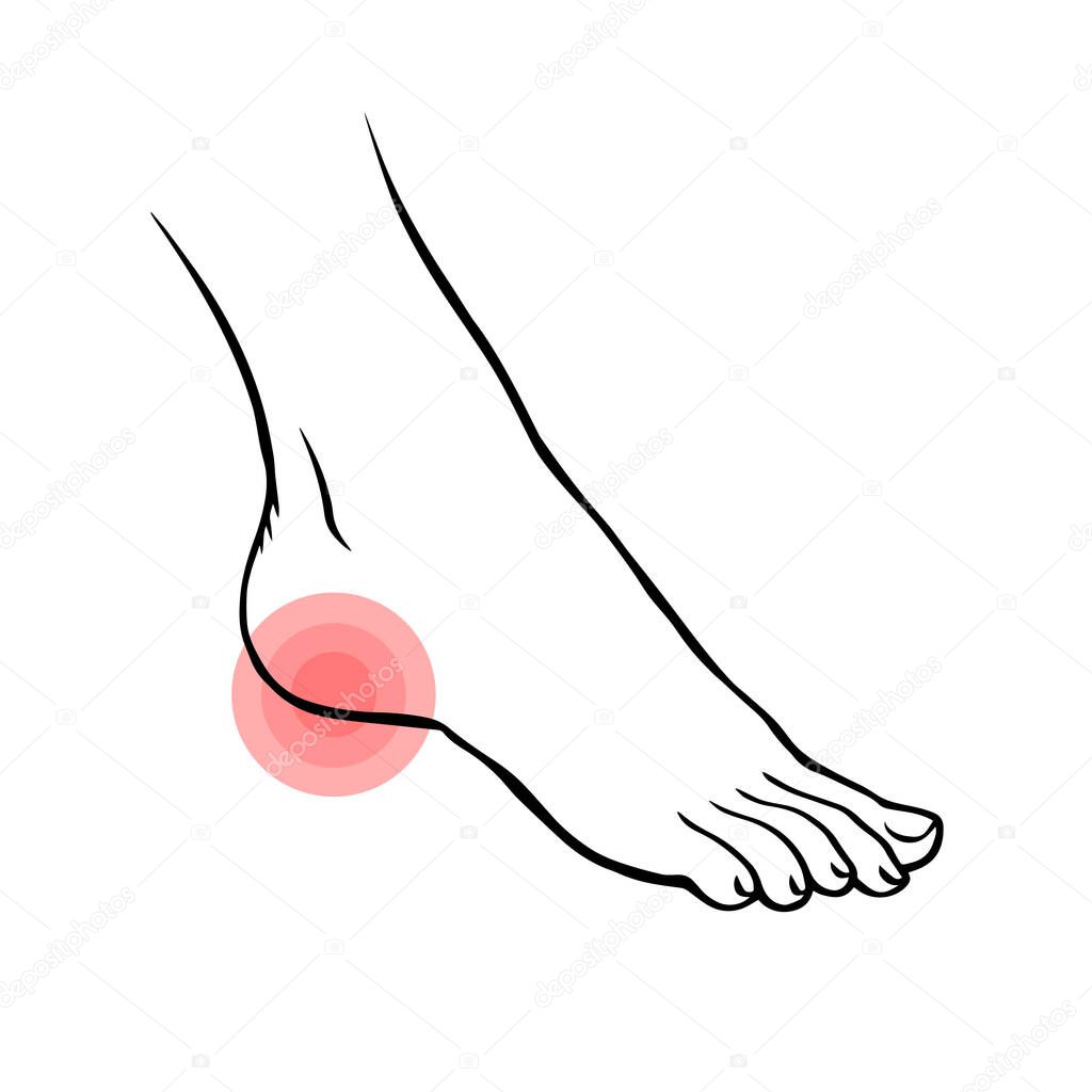 Leg with heel pain. Orthopedic disease plantar fasciitis. Beauty and health of feet. Vector isolated outline illustration