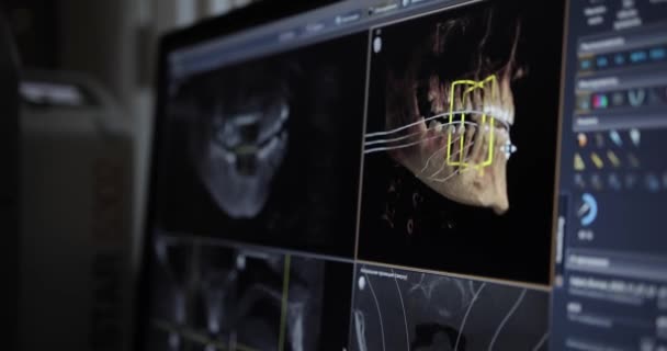 RM da mandíbula em uma clínica odontológica moderna. Imagem de ressonância magnética em uma tela de raios-x de pacientes. Equipamentos médicos de diagnóstico em odontologia moderna — Vídeo de Stock