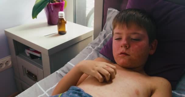 Viral disease. Measles rash. Child with viral infection measles lies in the bed and scratches himself — Stok Video