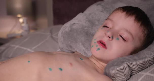 Een waterpokken zieke baby ligt op het bed, op het lichaam van een baby tante met kruiden. ongelukkige zieke baby liggend in bed. baby ziet er moe uit. — Stockvideo