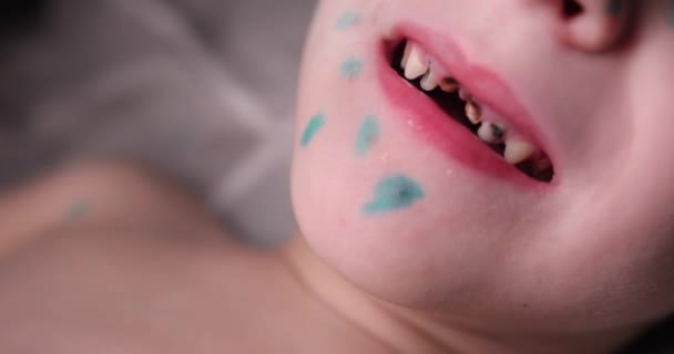 歯の悪い子供の口を閉じて。子供の歯の色がついています。子供の前の歯が悪い。少年たちは緑色で塗られた鶏水痘のにきびに直面しています — ストック動画