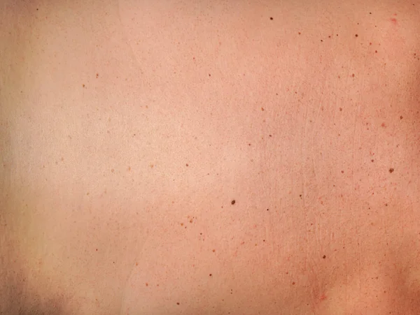 Деталь кожи спины с пигментными пятнами или отметкой дня рождения - молодая женщина загорает — стоковое фото