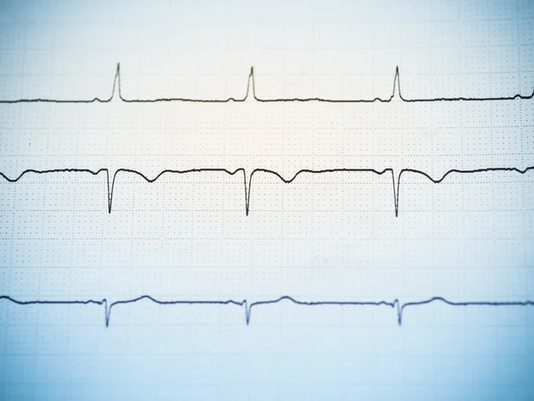 Gros plan d'un électrocardiogramme . — Photo