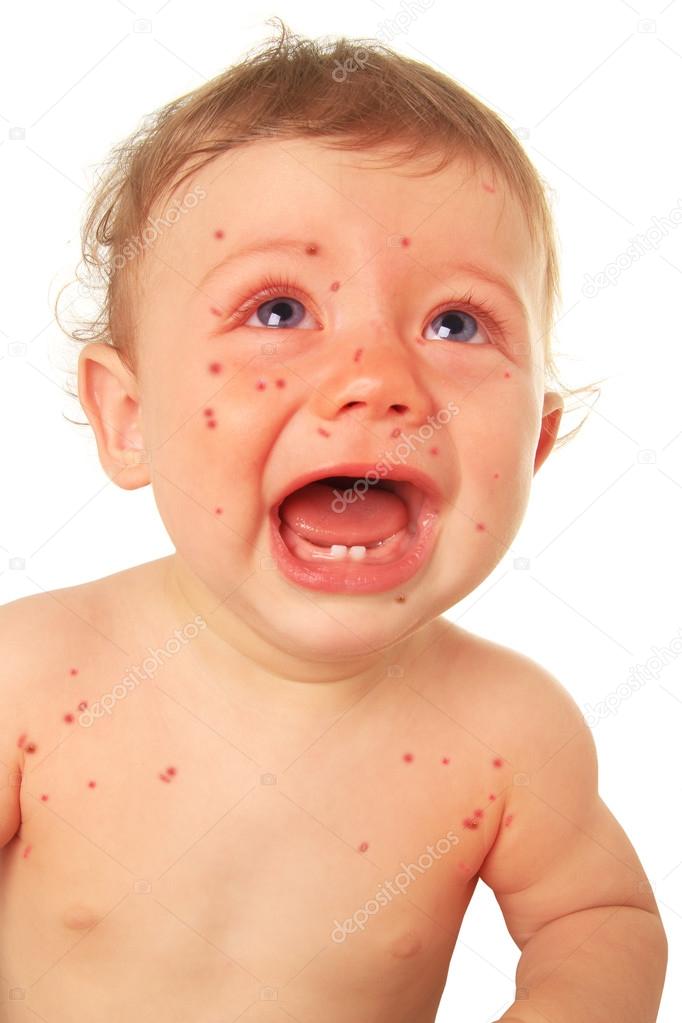 Crying baby boy with measles