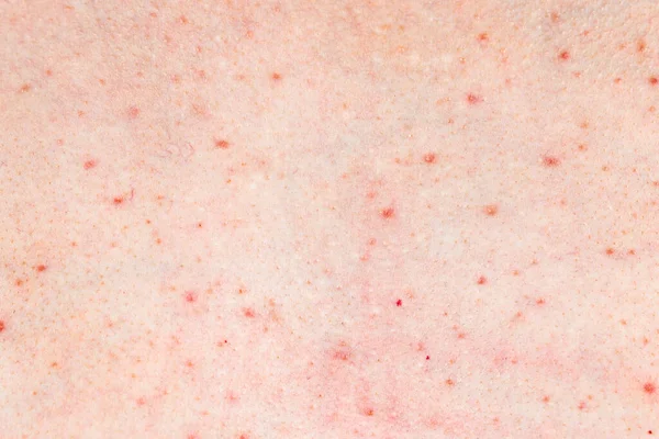 Skin Background Texture Pimples Blackheads Problematic Skin Close Acne Diseases — Stock Photo, Image