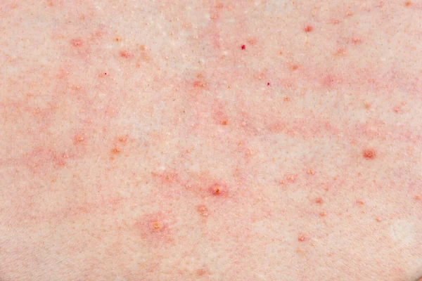 Skin Background Texture Pimples Blackheads Problematic Skin Close Acne Diseases — Stock Photo, Image