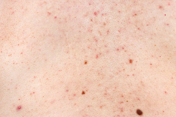 Hintergrundstruktur Der Haut Mit Pickeln Und Mitessern Problemhaut Hautnah Akne — Stockfoto