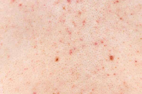 Hud Bakgrund Textur Med Finnar Och Pormaskar Problematisk Hud Närbild — Stockfoto